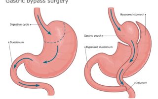 Gastric bypass surgery los angeles