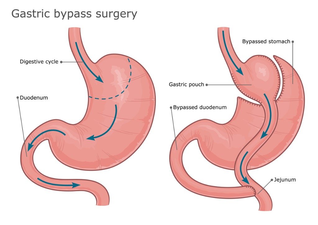 Gastric bypass surgery los angeles