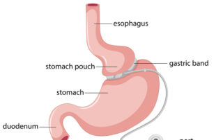 Lap Band Surgery Requirements