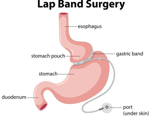Lap Band Surgery Requirements: What You Need To Know