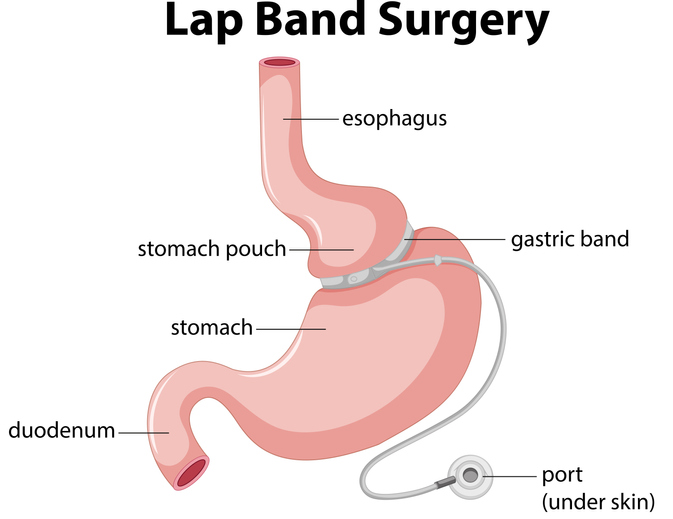 Lap Band Surgery Requirements