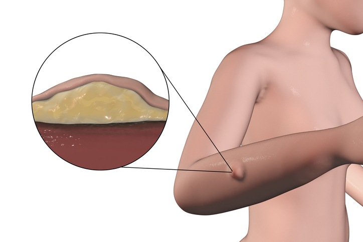 lipoma weight loss