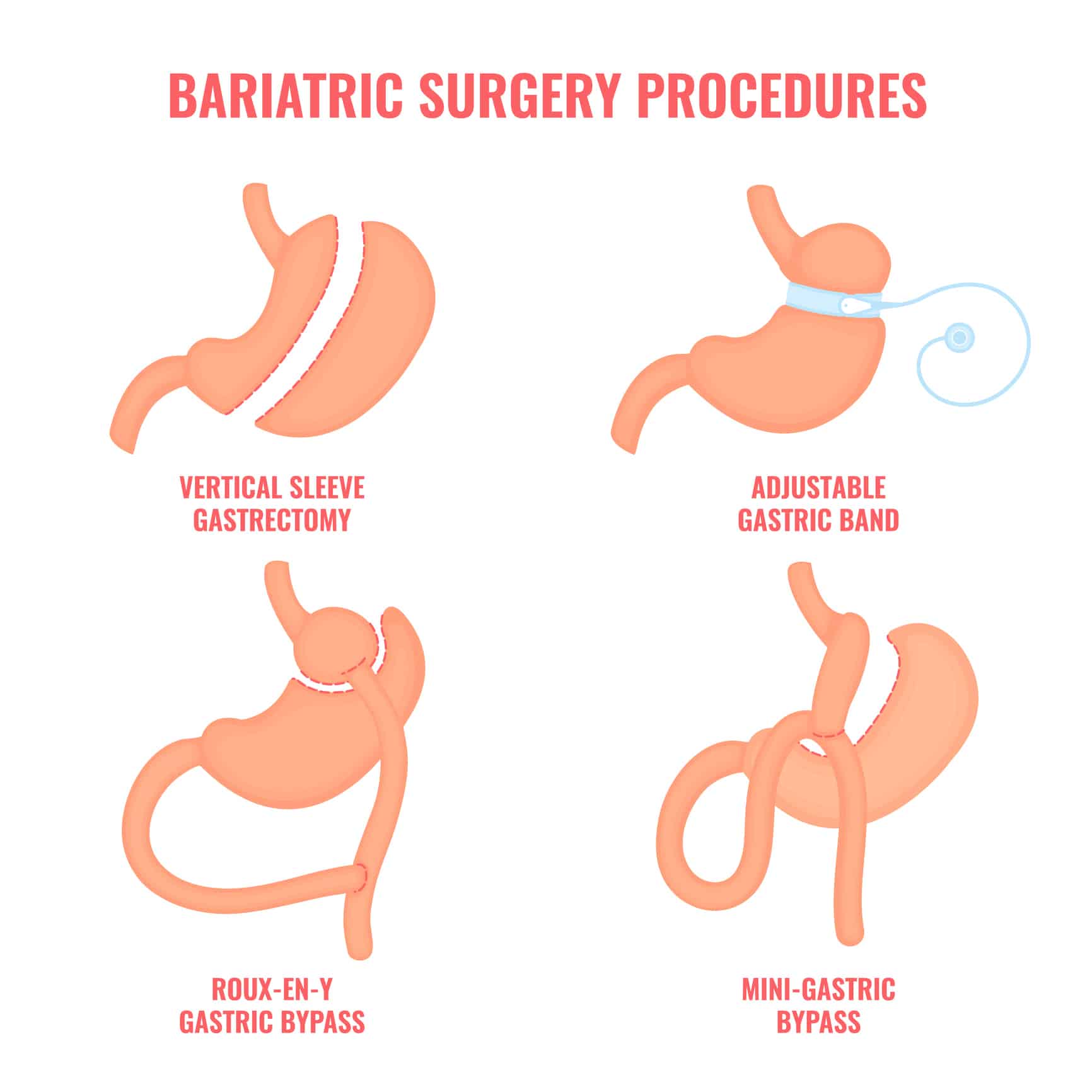 Gastric Sleeve Surgery